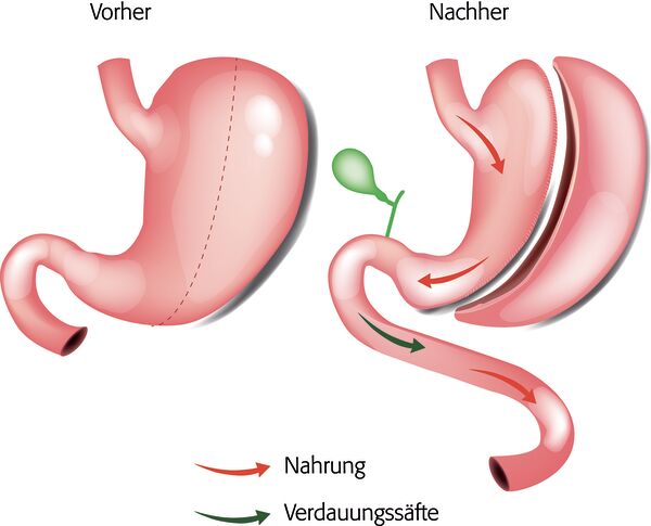 Abbildung Schlauchmagen